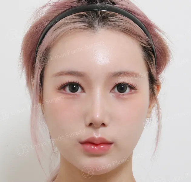 鼻子重修，術後，正面，案例 VEvYx