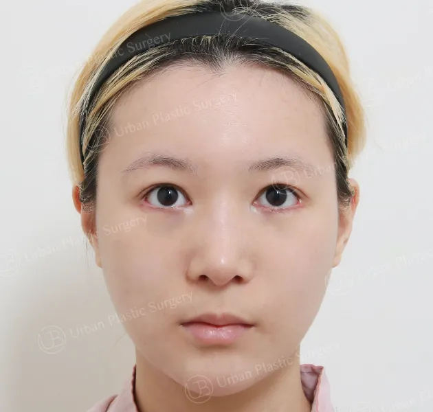 鼻子重修，術前，正面，案例 VEvYx
