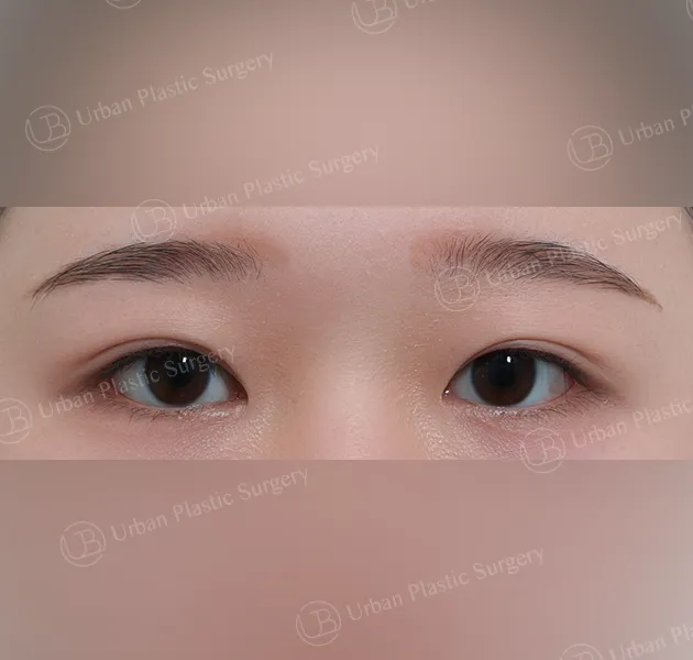 Non-incisional ptosis correction, After, Front
