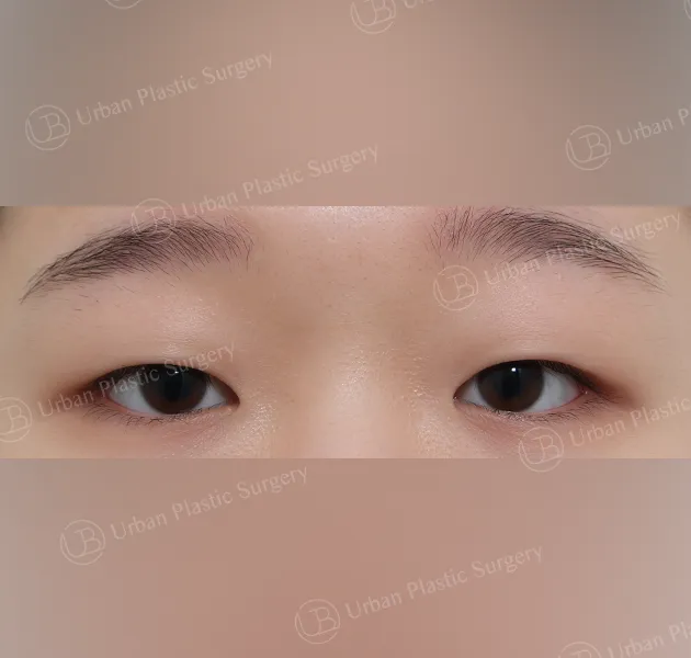 Non-incisional ptosis correction, Before, Front