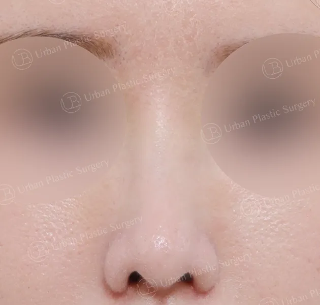 Open rhinoplasty, After, Front
