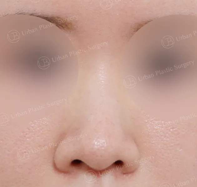 Open rhinoplasty, Before, Front
