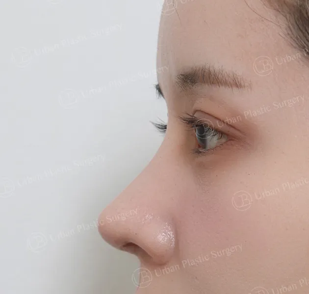 Open rhinoplasty, After, Side