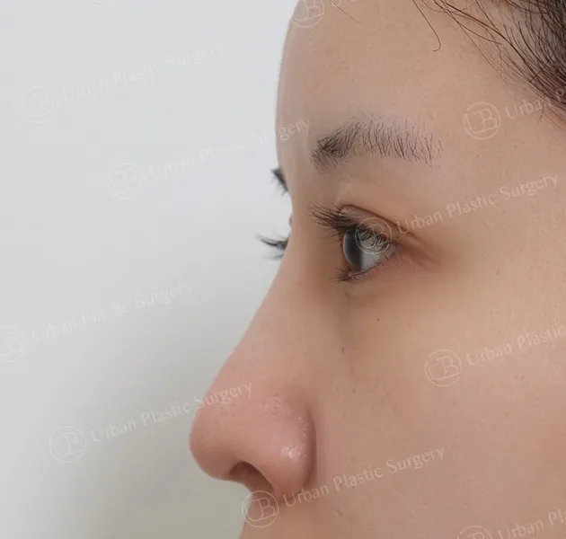 Open rhinoplasty, Before, Side