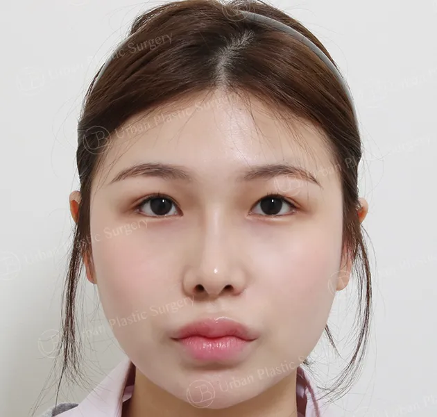 Eye revision, After, Front