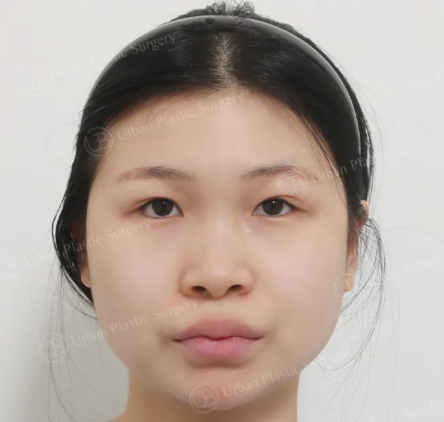 Eye revision, Before, Front