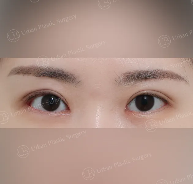 Incisional ptosis correction, After, Front