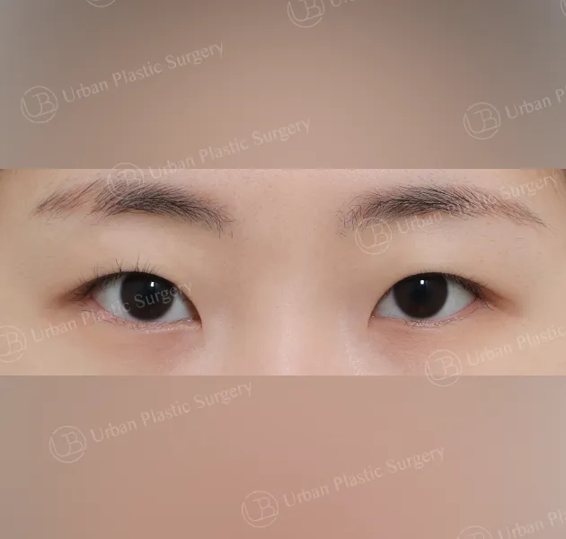 Incisional ptosis correction, Before, Front