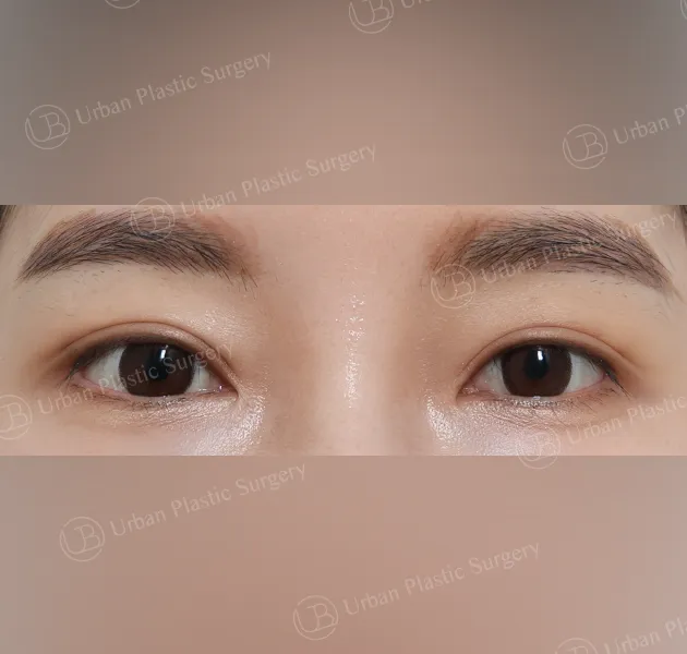 Suture double eyelid, After, Front, Case YaVny