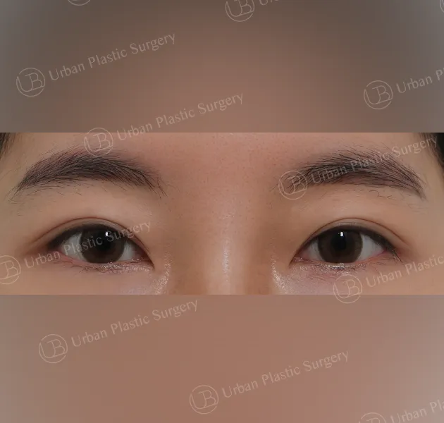 Suture double eyelid, Before, Front, Case YaVny