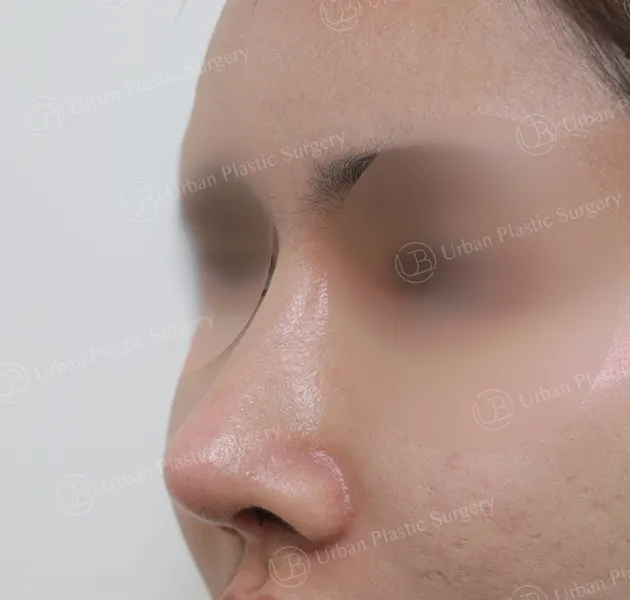 Open rhinoplasty, After, 45°