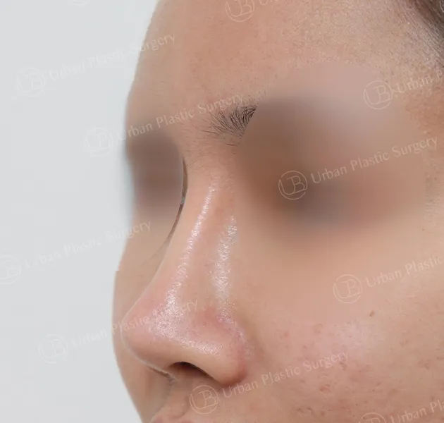 Open rhinoplasty, Before, 45°