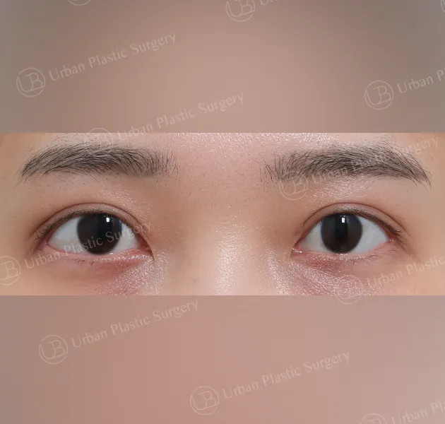 Incisional ptosis correction, After, Front
