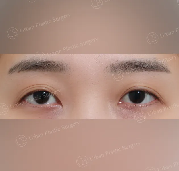 Incisional ptosis correction, Before, Front