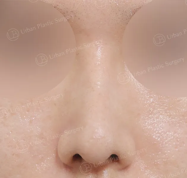 Open rhinoplasty, After, Front