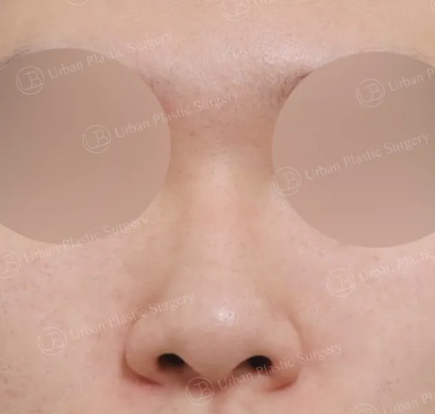 Open rhinoplasty, Before, Front