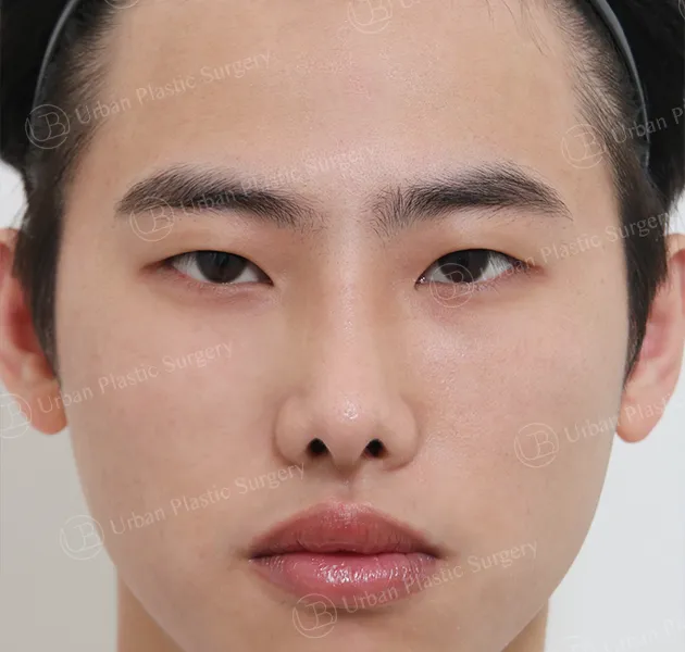 Rhinoplasty, After, Front, Case at4fF
