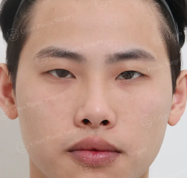 Rhinoplasty, Before, Front, Case at4fF