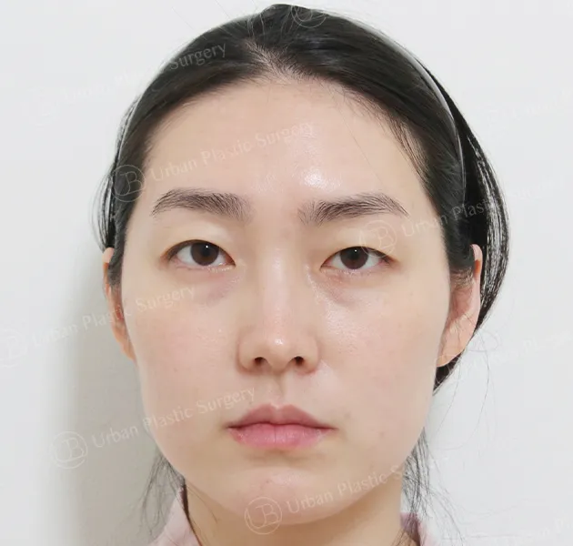 Eyes, Before, Front