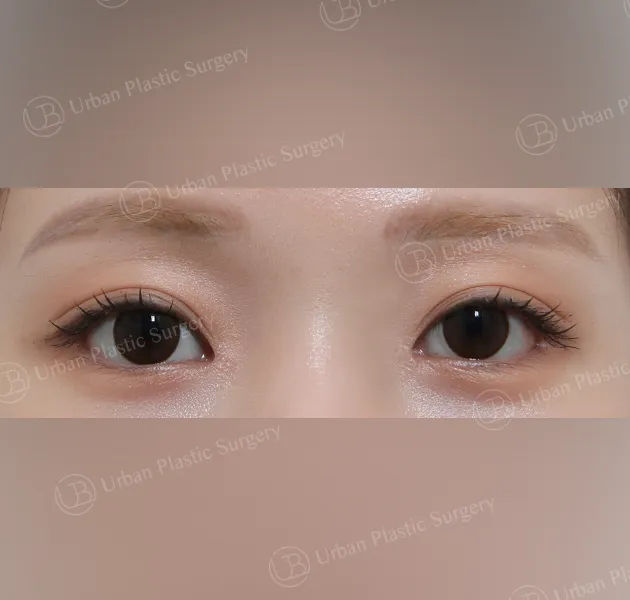 Inner corner reversal, After, Front, Case cUkid