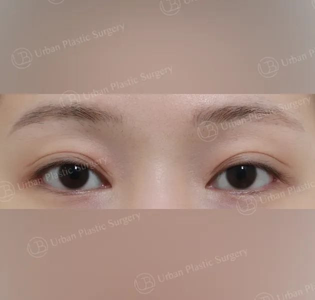 Inner corner reversal, Before, Front, Case cUkid