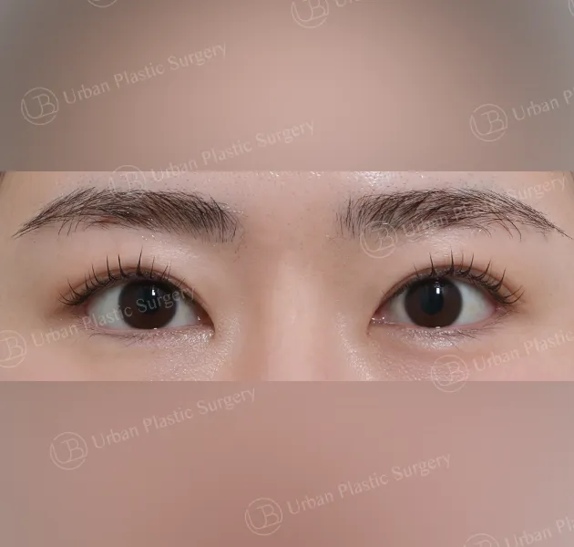 Outer corner (lateral canthoplasty), After, Front