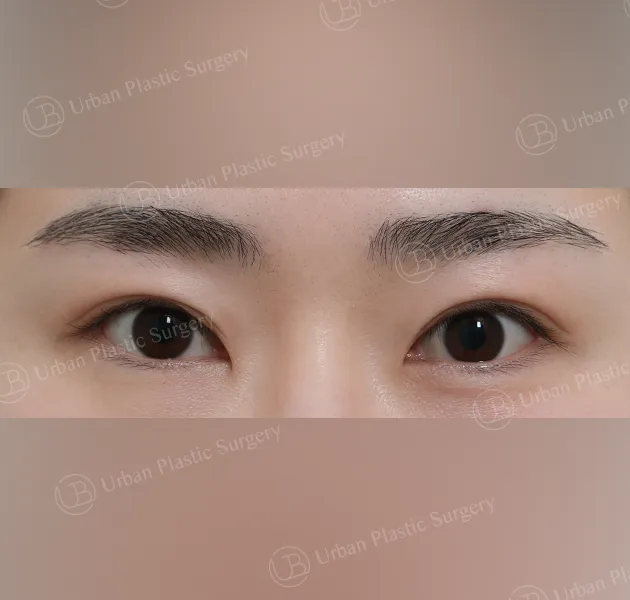 Outer corner (lateral canthoplasty), Before, Front