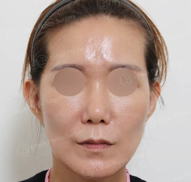 Facelift, After, Front, Case deQt2