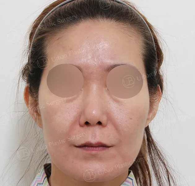 Facelift, Before, Front, Case deQt2