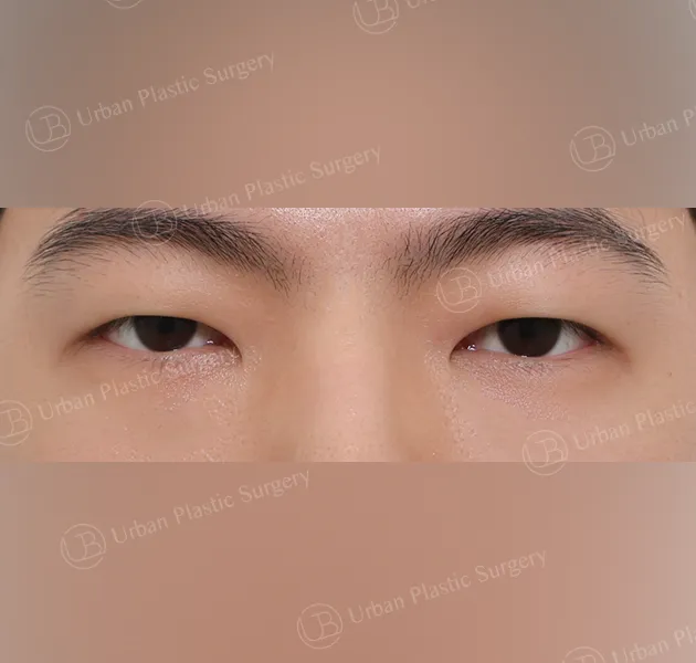 Under-eye fat repositioning, After, Front, Case dprYv