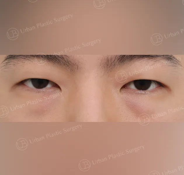 Under-eye fat repositioning, Before, Front, Case dprYv