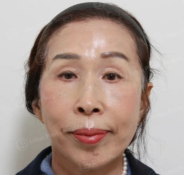Anti-aging, After, Front, Case ds2n3