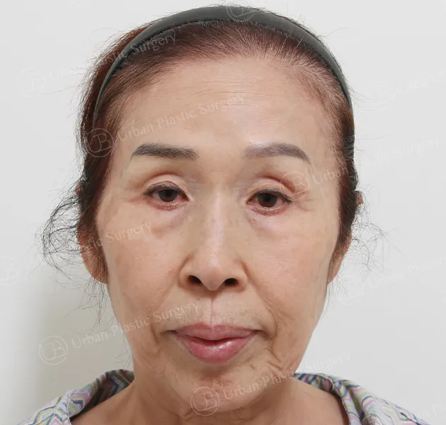 Anti-aging, Before, Front, Case ds2n3