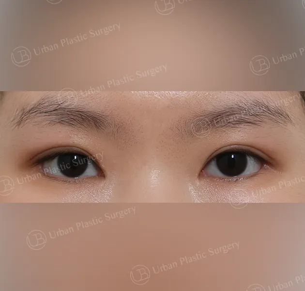 Outer corner (lateral canthoplasty), After, Front
