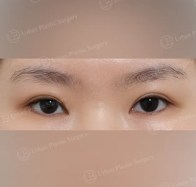 Outer corner (lateral canthoplasty), Before, Front