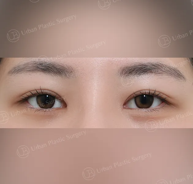 Non-incisional ptosis correction, After, Front