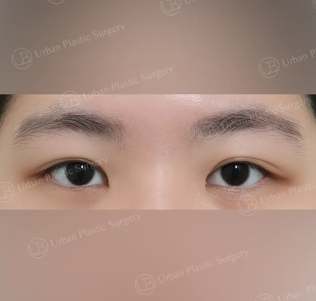 Non-incisional ptosis correction, Before, Front