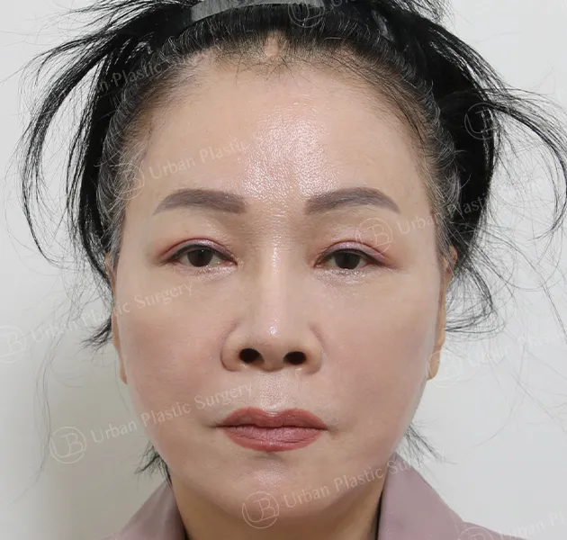 Anti-aging, After, Front