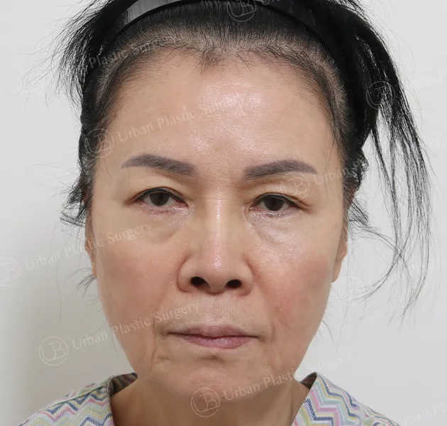 Anti-aging, Before, Front