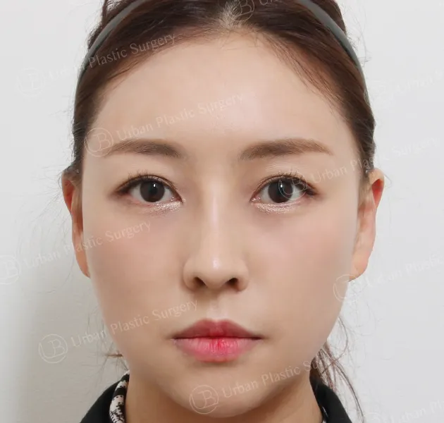 開放式隆鼻,術後,正面,案例 gAZfZ