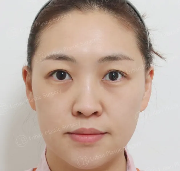 開放式隆鼻,術前,正面,案例 gAZfZ