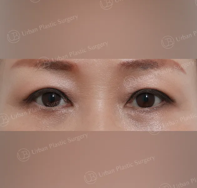 Under-eye fat repositioning, After, Front