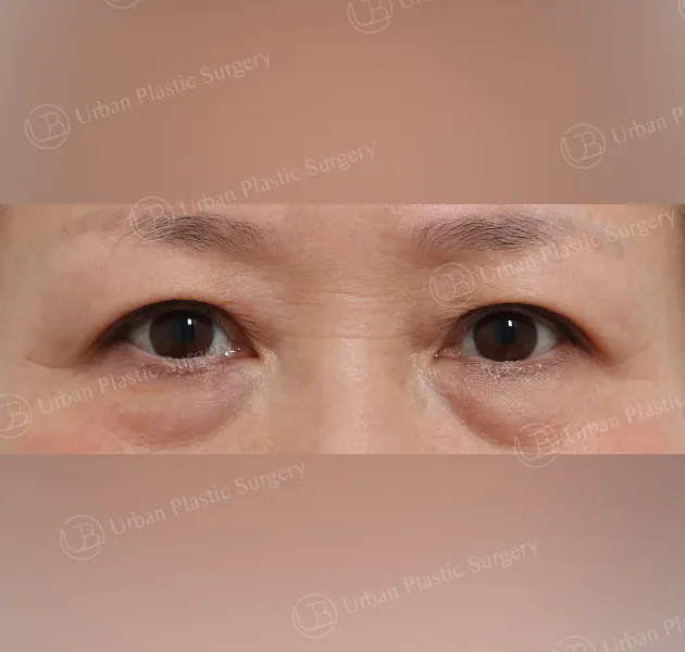 Under-eye fat repositioning, Before, Front