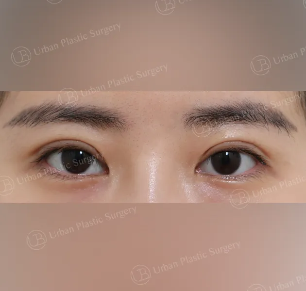 Non-incisional ptosis correction, After, Front, Case gt99m