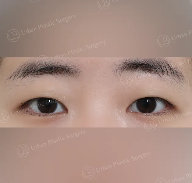 Non-incisional ptosis correction, Before, Front, Case gt99m