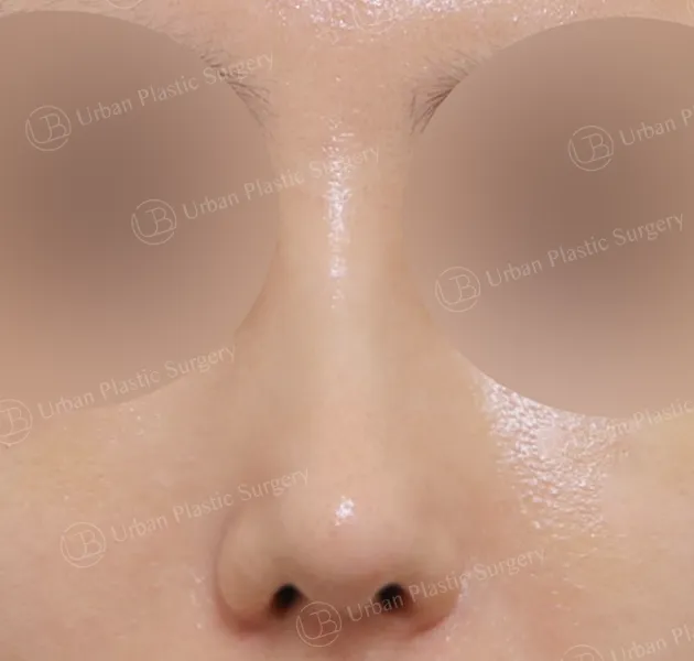 Open rhinoplasty, After, Front