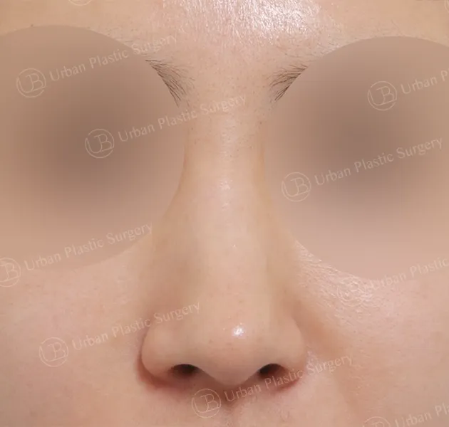 Open rhinoplasty, Before, Front
