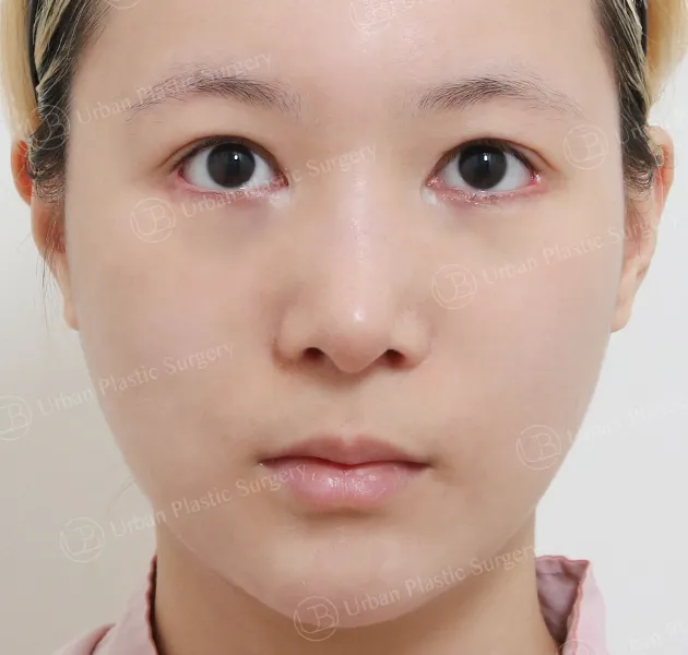 鼻子重修，術前，正面，案例 itH75