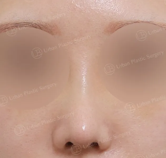 Open rhinoplasty, After, Front
