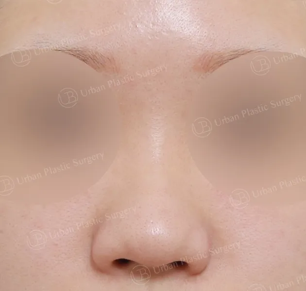 Open rhinoplasty, Before, Front